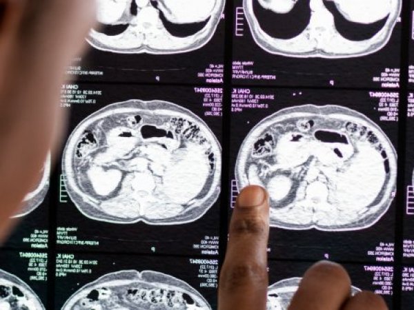 Resonancia magnética de cerebro