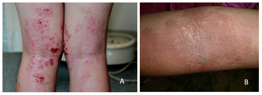 Persona con Dermatitis Atópica