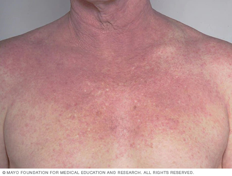 Persona adulta con Dermatitis Atópica