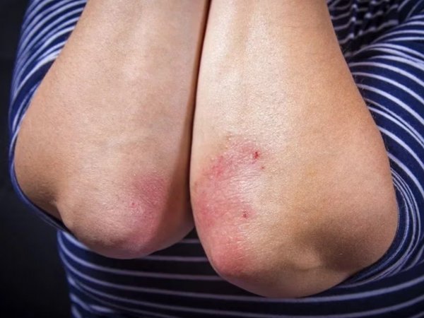 Dermatitis atópica, qué es.