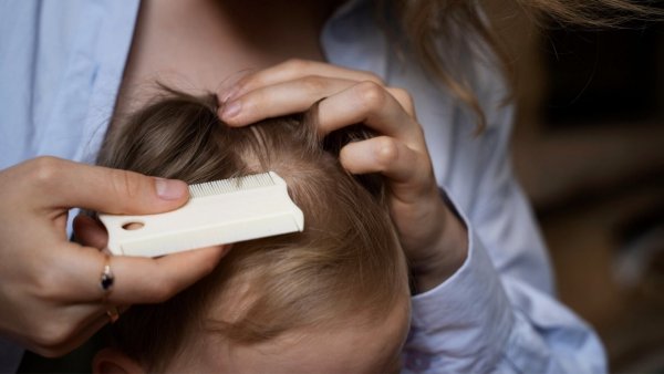 Piojos. Qué significa soñar con piojos.