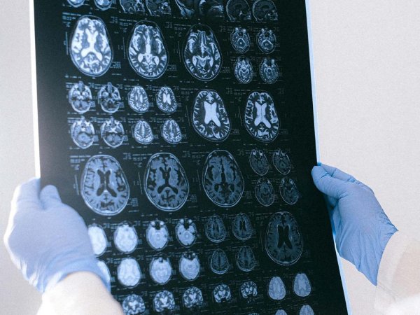 Neurólogo explicando los síntomas y prevención del accidente cerebrovascular (ACV) a un grupo de pacientes. Chile, 2024.