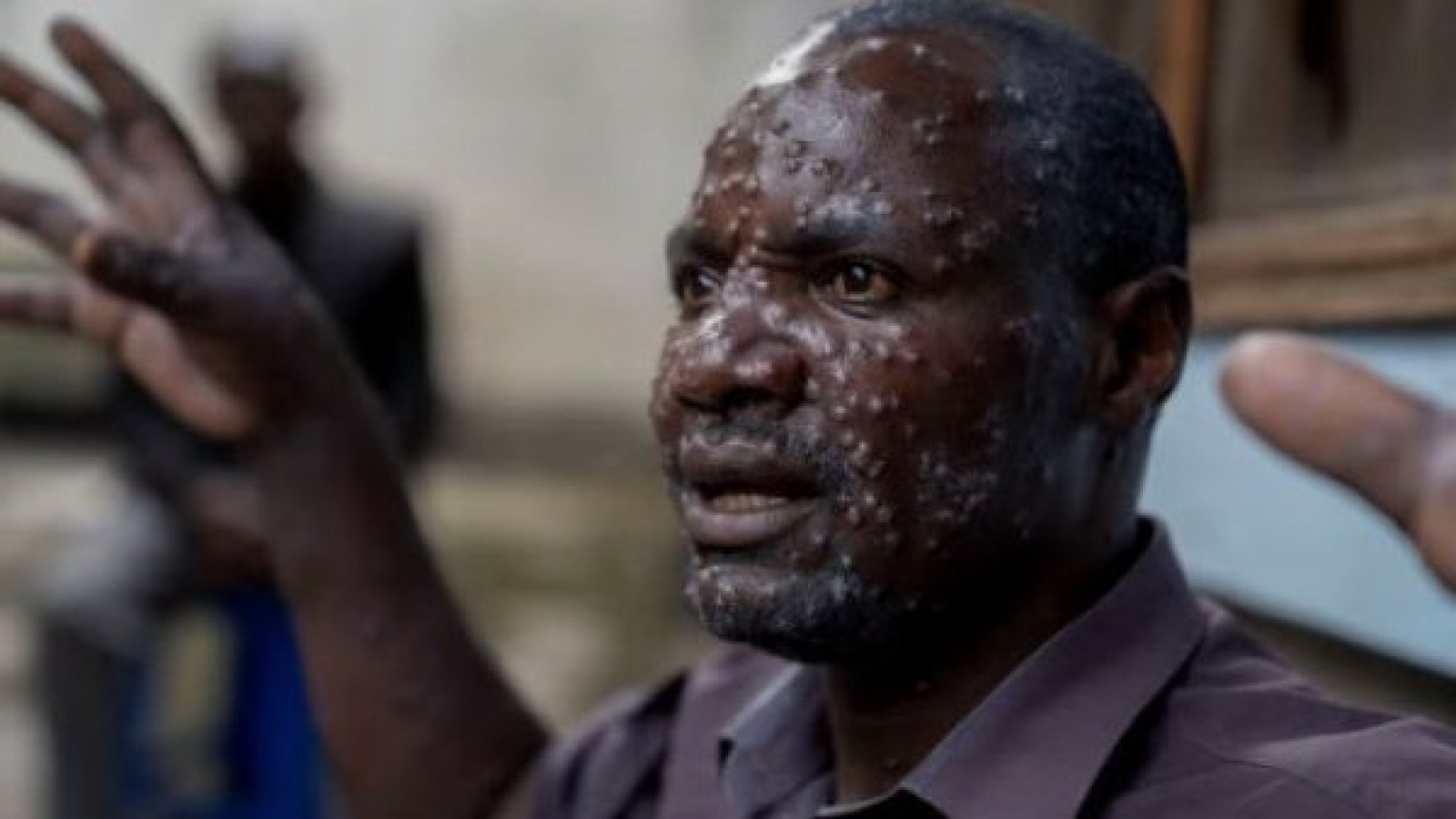 Hombre padeciente de mpox, la enfermedad que solía ser la viruela del mono