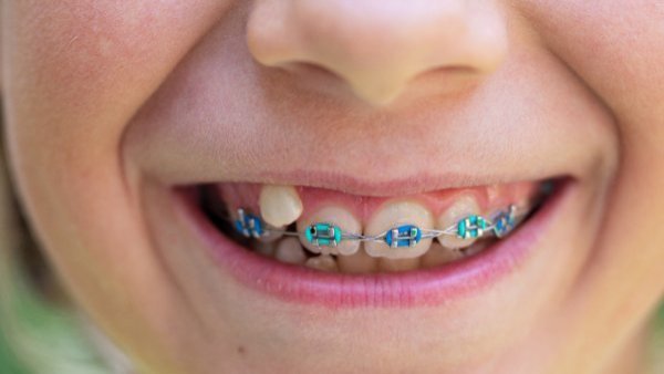 Ortodoncia preventiva