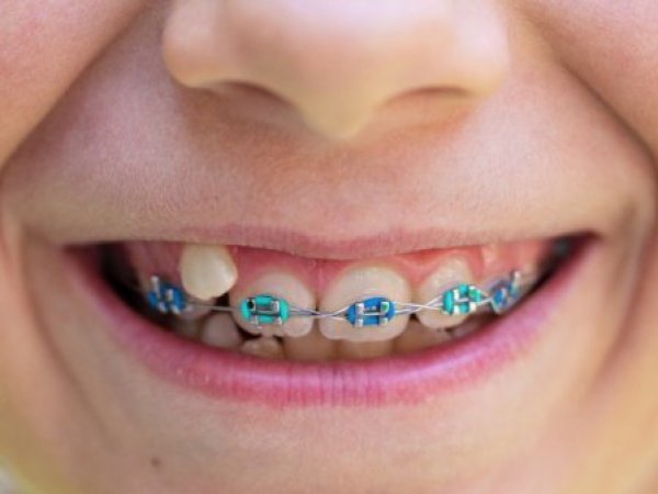 Ortodoncia preventiva