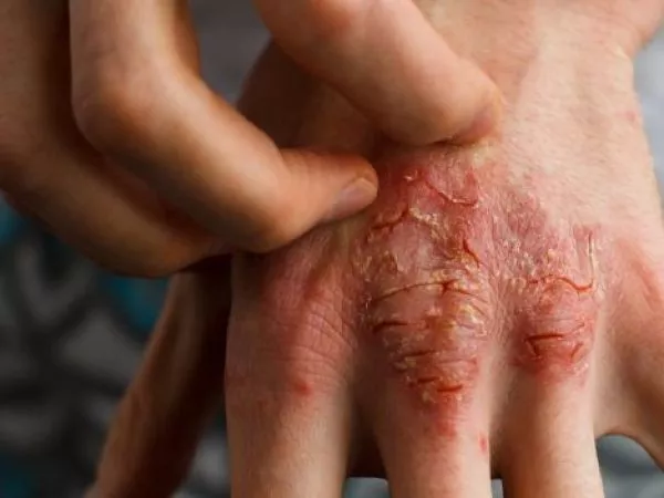 Dermatitis Atópica: los costos económicos y psicológicos de una enfermedad sin cobertura en Chile