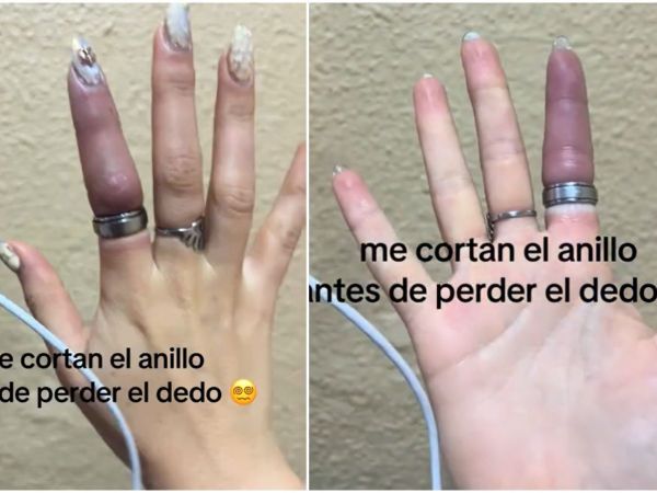 Anillo queda atrapado en dedo de mujer argentina