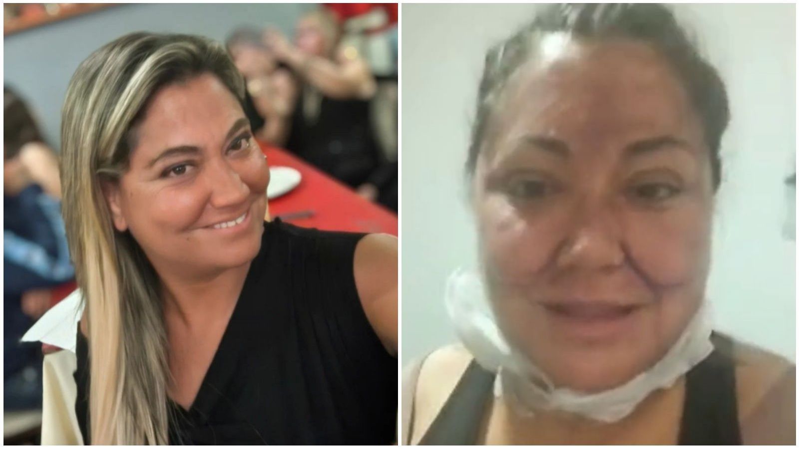 Denisse Campos tras procedimientos estéticos