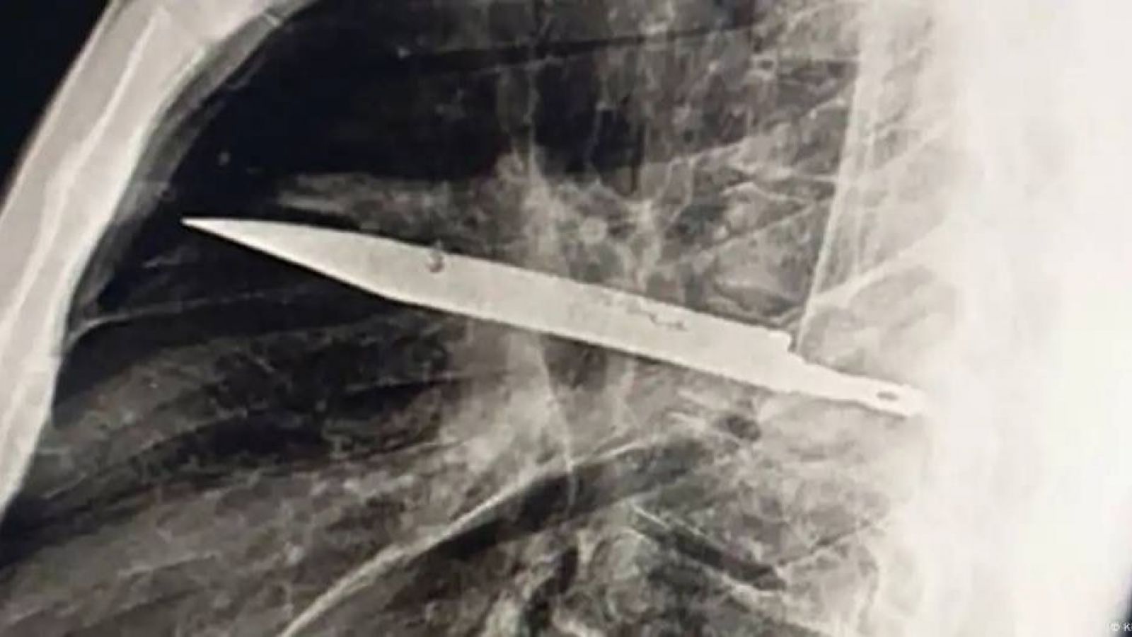 CUCHILLO EN EL TORAX