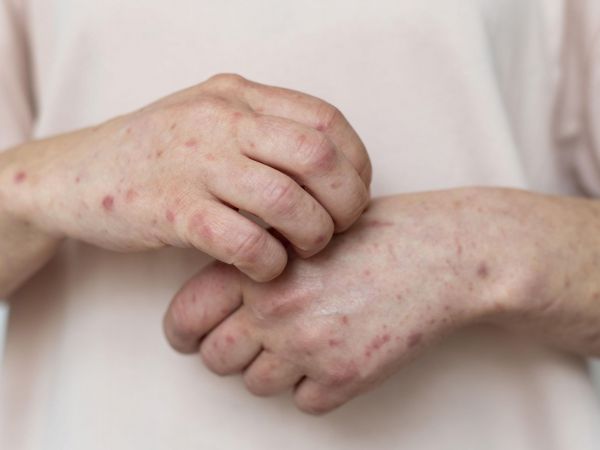 Contado de sarampión en La Araucanía