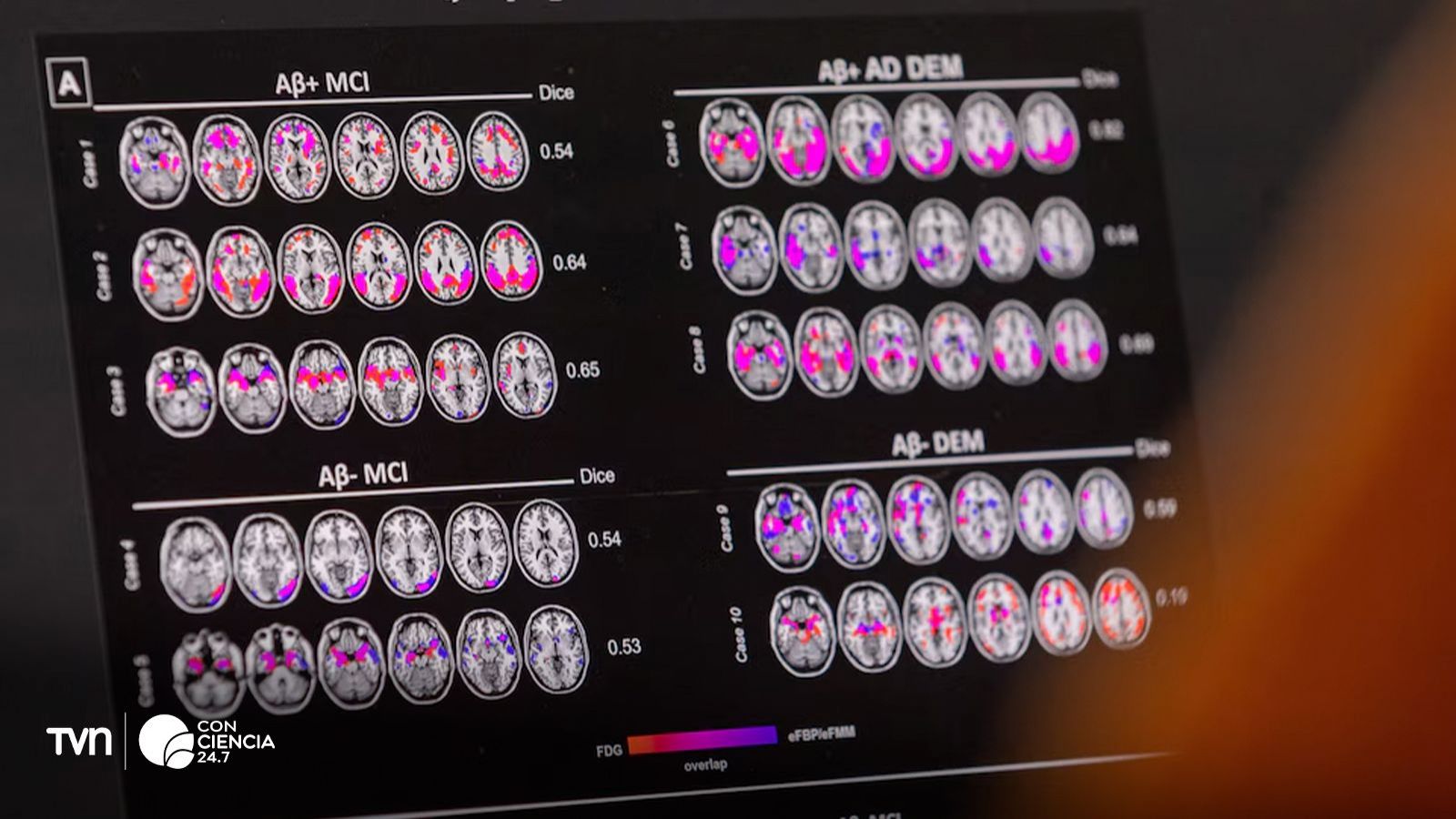 Radiografías del cerebro de personas con Alzheimer.