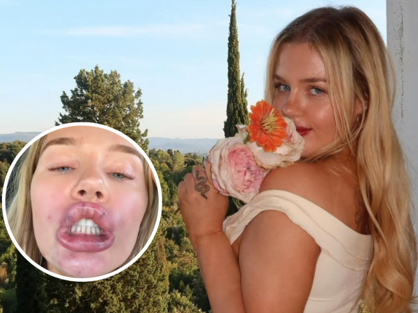 Influencer se vuelve viral luego de mostrar el resultado de su relleno de labios