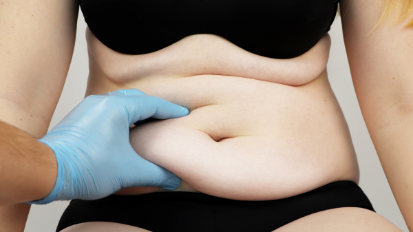 Doctor realizando un diagnóstico para una abdominoplastía