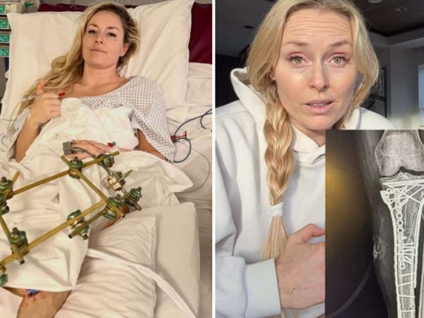 Lindsey Vonn contando sobre la compleja lesión que sufrió en los Juegos Olímpicos