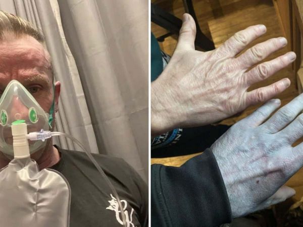 Tommy Lynch mostrando cómo quedó azul tras despertar