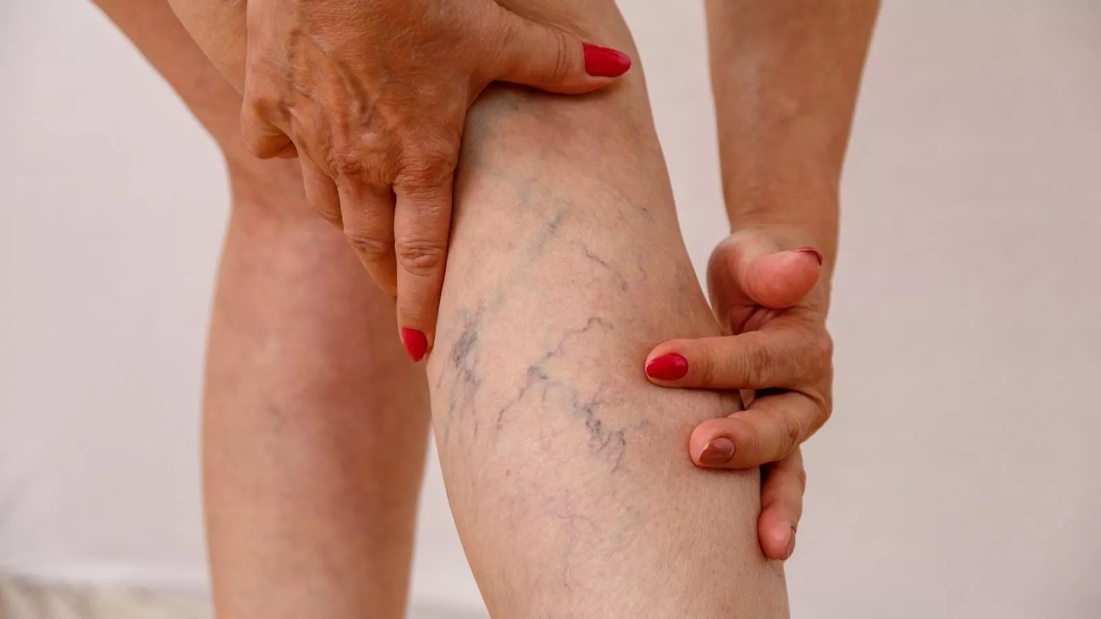 Persona con várices en sus piernas