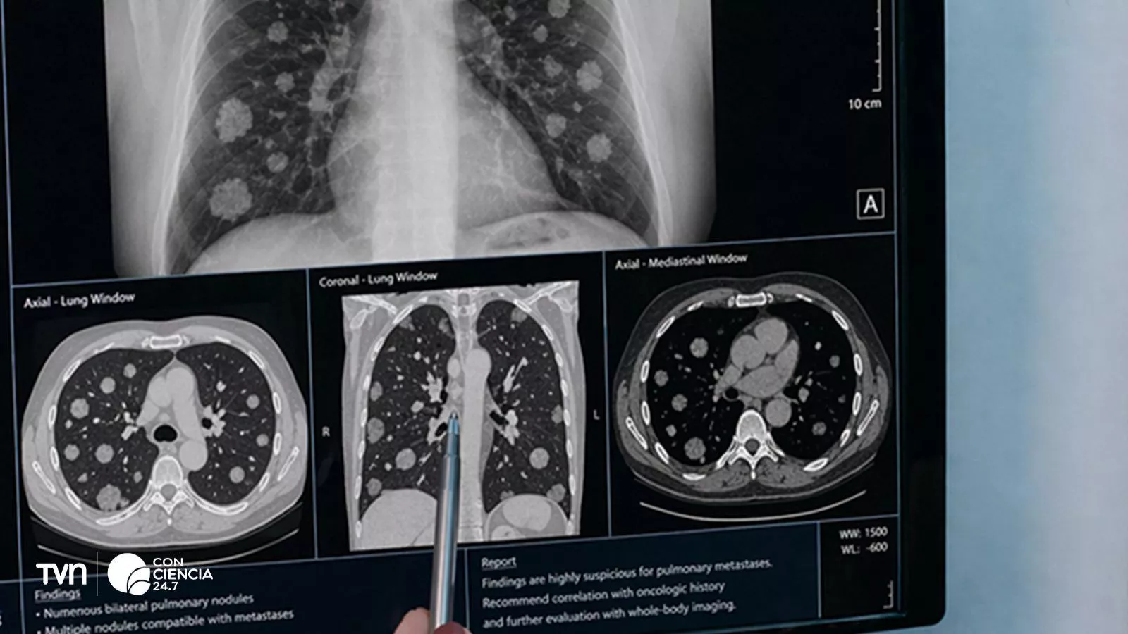 Base de datos con IA mejora seguimiento del cáncer en Chile.