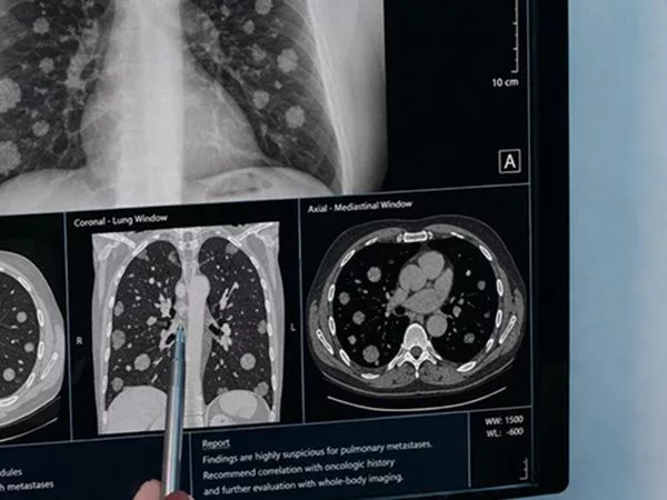 Base de datos con IA mejora seguimiento del cáncer en Chile.