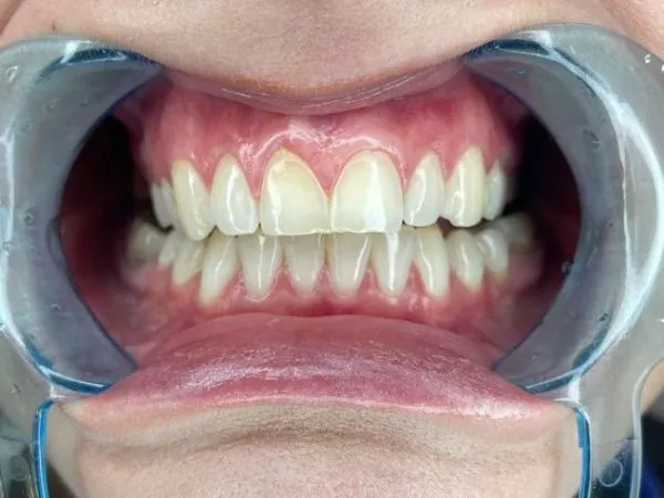El silencioso problema de salud bucal que afecta al 90% de las personas