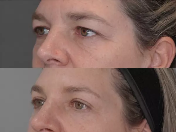Blefaroplastia: ¿Qué es esta cirugía?
